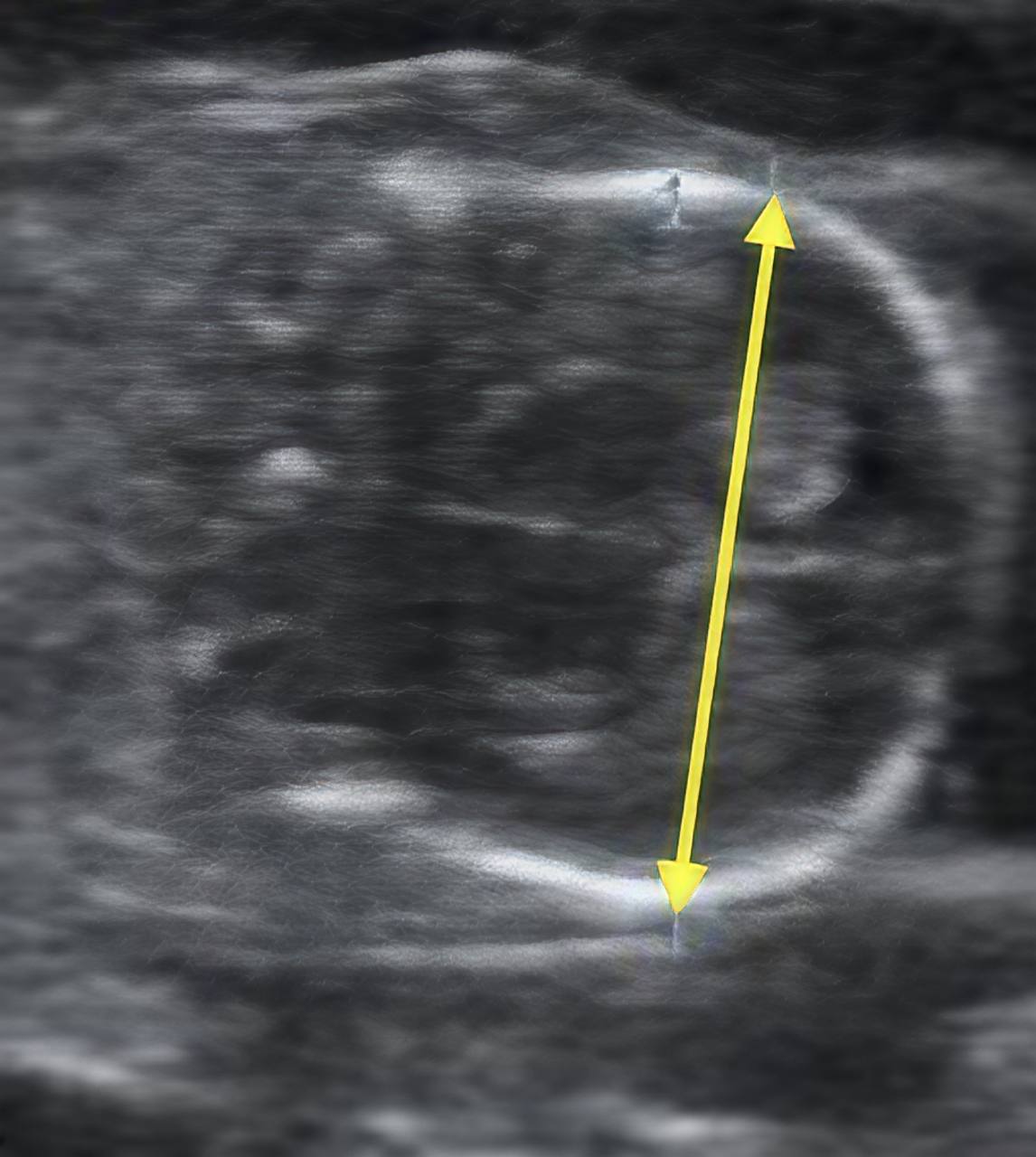Canine fetal ultrasound demonstrating biparietal diameter measurement across the parietal bones.